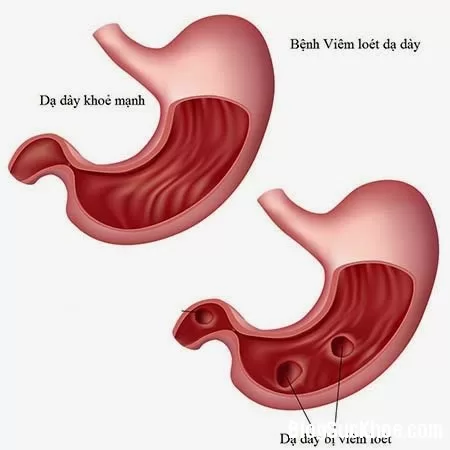 Những quan niệm và cách chữa bệnh loét dạ dày sai lầm