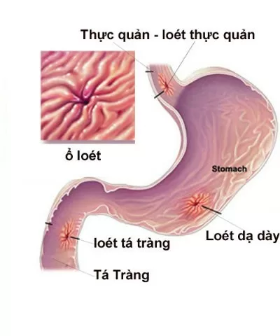 Những điều cần biết về viêm dạ dày