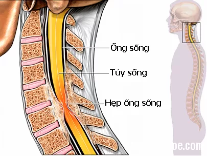 Nguyên nhân, triệu chứng và điều trị thoát vị đĩa đệm cổ