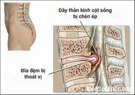 Chữa thoát vị đĩa đệm bằng thuốc Nam