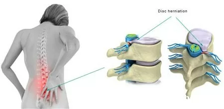 Điều trị thoát vị đĩa đệm cột sống thắt lưng