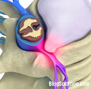 Các bài kiểm tra chẩn đoán thoát vị đĩa đệm quan trọng