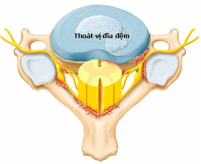 Chẩn đoán thoát vị đĩa đệm
