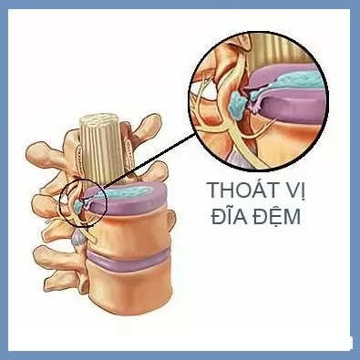 Làm thế nào để chữa một đĩa đệm đã bị thoái vị?