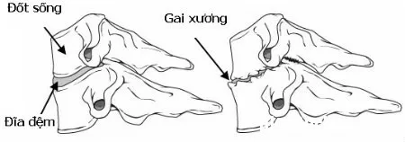Bệnh gai cột sống cổ