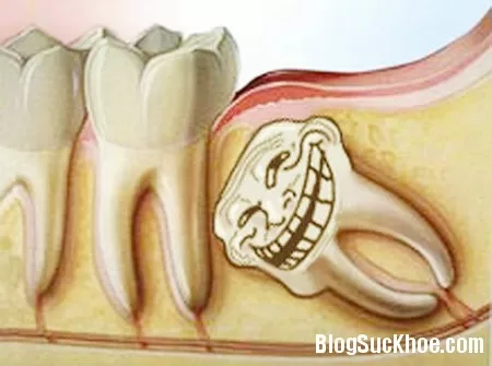 Những điều cần biết về răng khôn