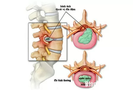 Tiêm Steroid giảm đau dây thần kinh tọa do thoát vị đĩa đệm