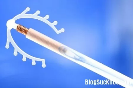 Ưu điểm khi sử dụng vòng tránh thai đúng cách
