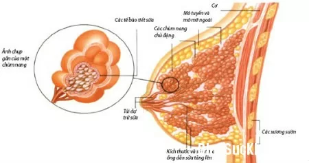 Những bệnh tuyến vú lành tính thường gặp