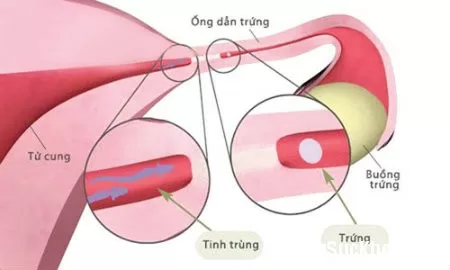 Cẩn trọng khi vòi trứng bị ách tắc