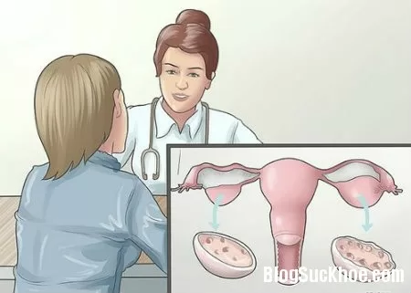 Dấu hiệu nhận biết hội chứng buồng trứng đa nang