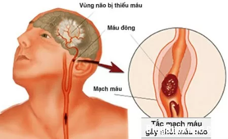 Các biểu hiện của rối loạn tuần hoàn não