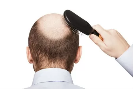 Vấn đề rụng tóc ở đàn ông