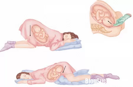 Dấu hiệu nhận biết sa dây rau ở thai phụ