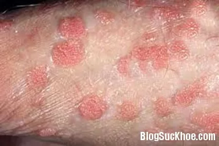 Những dấu hiệu bệnh mụn rộp sinh dục