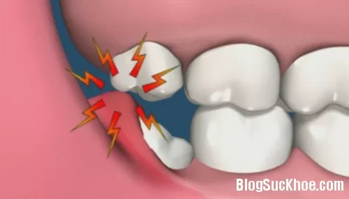 Những điều cần biết về răng khôn