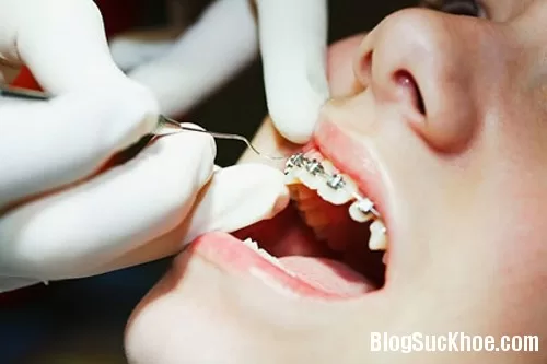 Cách chăm sóc răng miệng sau khi niềng