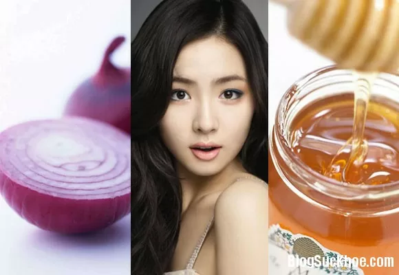 Trị mụn đơn giản hiệu quả bằng hành tây