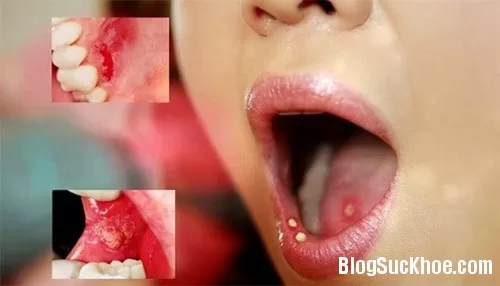 Dấu hiệu bệnh ung thư vòm họng