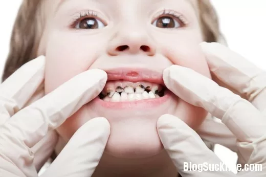 Các bệnh phổ biến về răng miệng thường gặp ở trẻ nhỏ