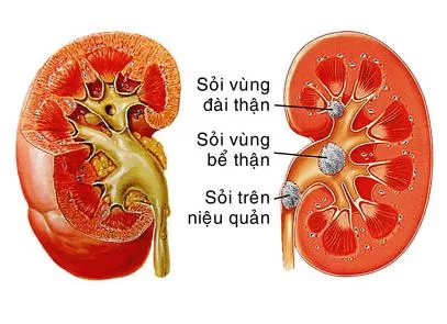 Bệnh sỏi thận nhiều cách chữa nhưng dễ tái phát