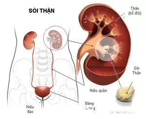 Sự liên quan giữa sỏi thận và bệnh suy thận