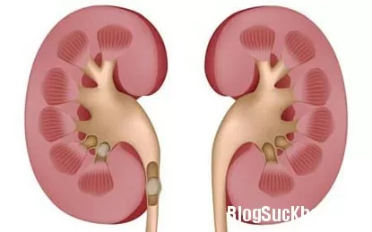 Phương pháp chẩn đoán sỏi thận