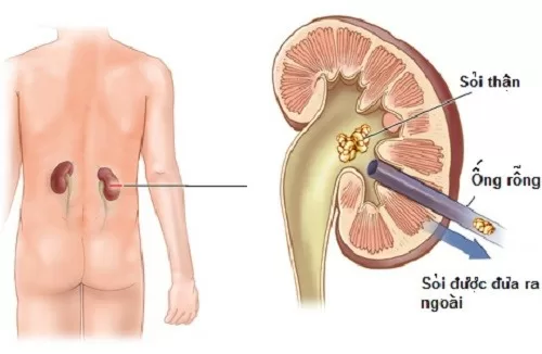 Không nên chủ quan với bệnh sỏi thận