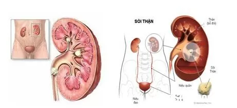 Các loại sỏi thận thường gặp