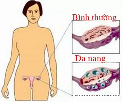Điều trị đa nang buồng trứng