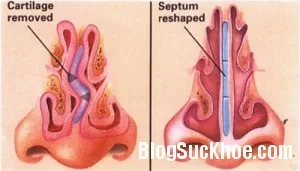 Triệu chứng vẹo vách ngăn mũi