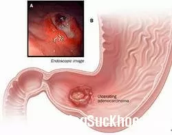 Thủ phạm gây ra chứng khó tiêu