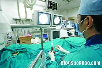 Phương pháp TOCE điều trị ung thư gan