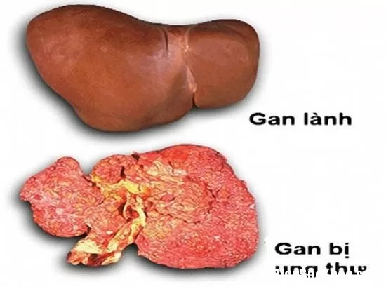 Các phương pháp điều trị ung thư gan