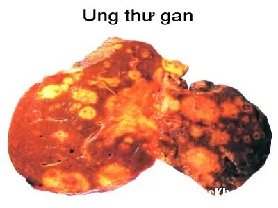 Các loại ung thư gan