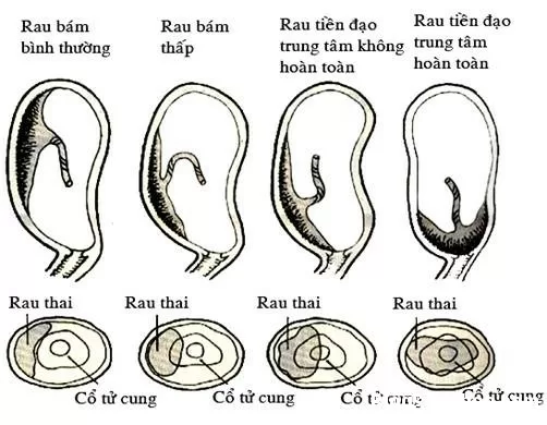 Biến chứng nhau tiền đạo khi mang thai