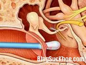 Dấu hiệu nhận biết khi bị thủng màng nhĩ