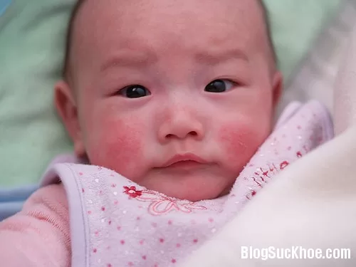 Phòng ngừa bệnh chàm cho trẻ