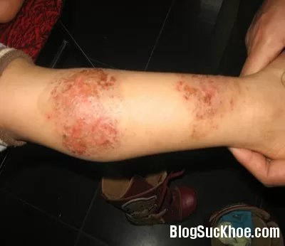 Các loại thuốc Nam thường dùng chữa bệnh chàm