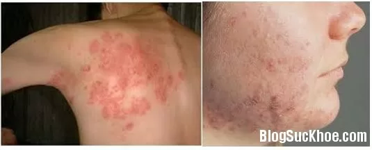Triệu chứng bệnh chàm