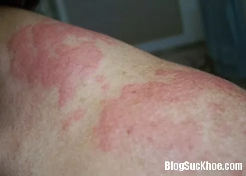 Biểu hiện lâm sàng bệnh eczema