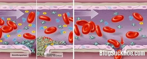 Triệu chứng của bệnh rối loạn đông máu