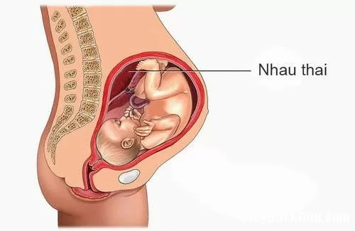 Biến chứng nguy hiểm khi phù nhau thai