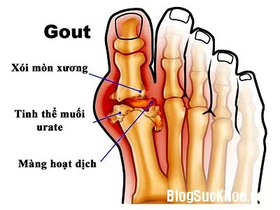 Dấu hiệu sớm nhất và đặc trưng của bệnh gút