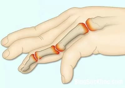 Đẩy lùi nguy cơ viêm khớp ngón tay