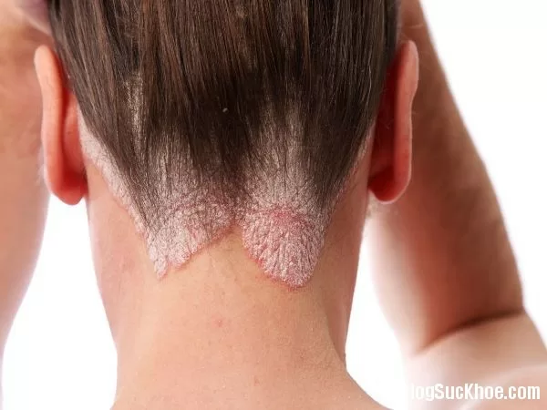 7 vị trí trên cơ thể dễ mắc ung thư da mà bạn không ngờ tới