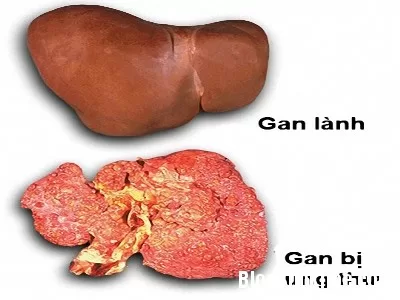 Những tác nhân có thể gây ung thư gan