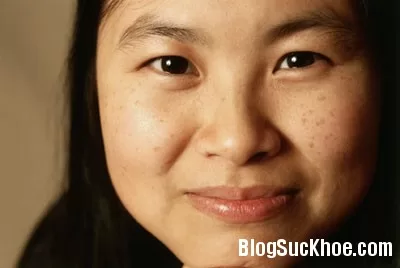 Phương pháp điều trị nám da