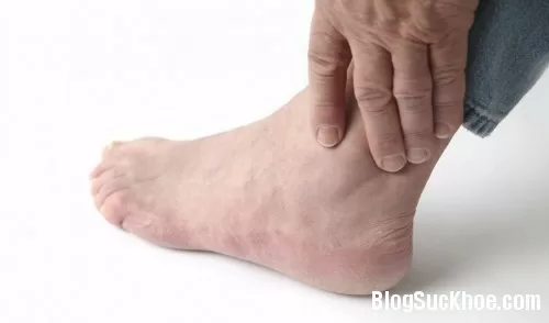 Biểu hiện nguy cơ mắc bệnh gút