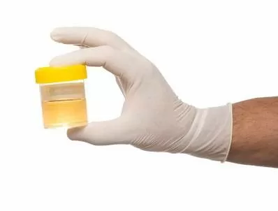 Cần làm gì khi nước tiểu có màu bất thường?